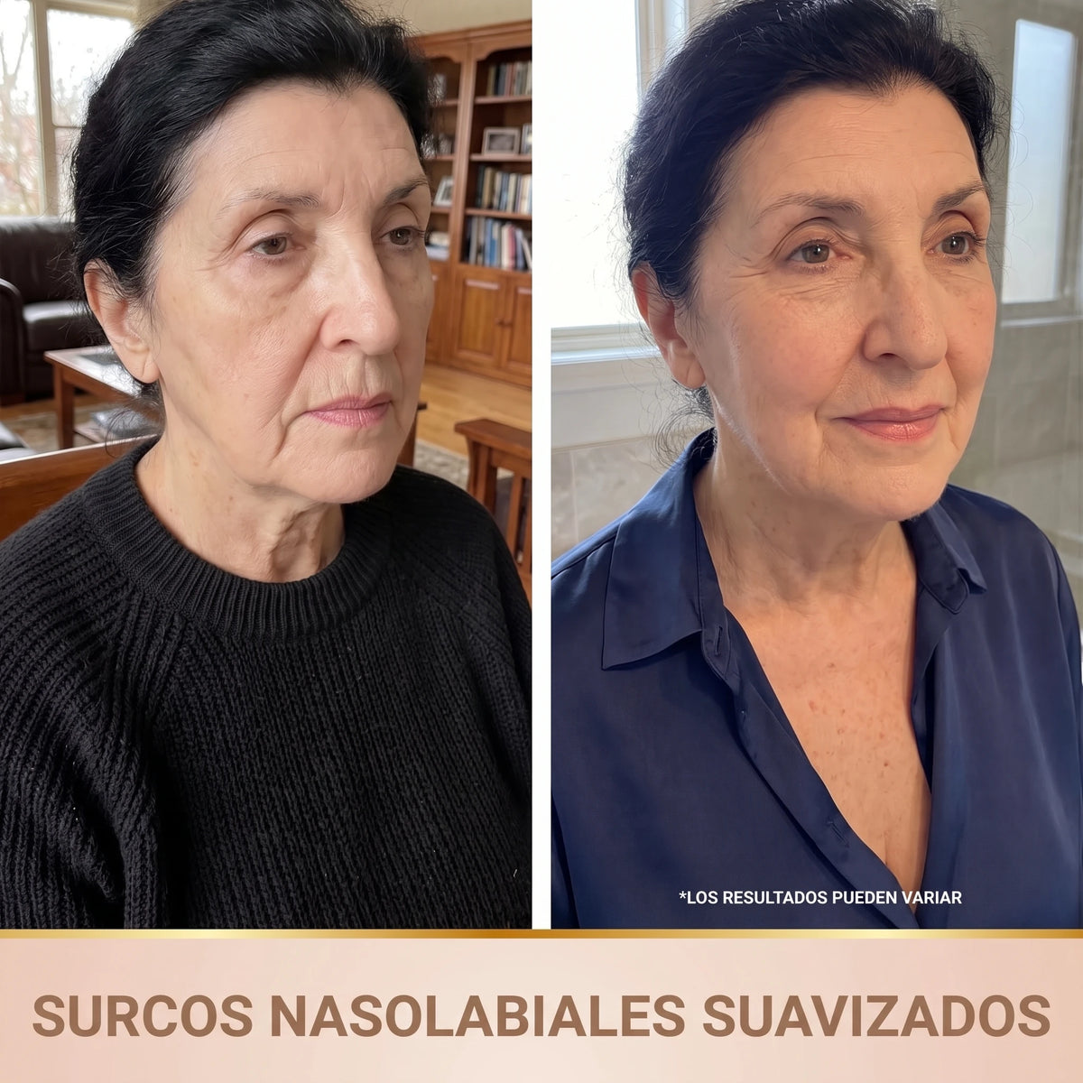 Antes y después: surcos nasolabiales suavizados